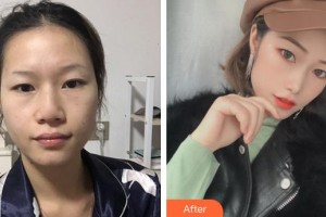 廈門美麗薇整形美容醫(yī)院李周憲整形價(jià)格表附埋線提升提升案例展示