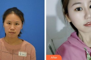 廈門美麗薇整形美容醫(yī)院樸晟皖整形價(jià)格表附鼻部手術(shù)案例展示