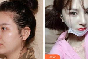 廈門蘭的整形外科門診部趙曉暉整形價(jià)格表附肋軟骨隆鼻案例展示