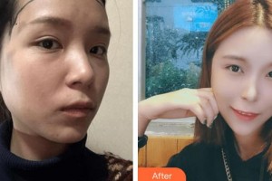 廈門銀河整形美容醫(yī)院李江濱整形價(jià)格表附女性發(fā)際線種植案例展示