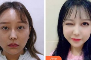 廈門市第三醫(yī)院眼科艾運(yùn)旗整形價(jià)格表附雙眼皮+眼瞼下至案例展示