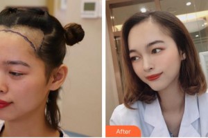 廈門重森植發(fā)整形外科門診部林先錦整形價(jià)格表附發(fā)際線種植案例展示