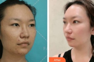 廈門大學(xué)附屬廈門眼科中心醫(yī)院盧奕整形價(jià)格表附雙眼皮案例展示