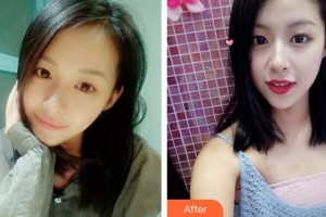 廈門大學(xué)附屬廈門眼科中心醫(yī)院陳偉整形價(jià)格表附精致雙眼皮案例展示