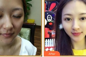 廈門大學(xué)附屬廈門眼科中心醫(yī)院張淳整形價(jià)格表附眼部多項(xiàng)案例展示