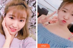 廈門大學(xué)附屬廈門眼科中心醫(yī)院李煒整形價(jià)格表附切開雙眼皮案例展示