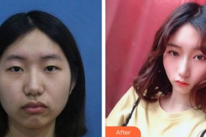 廈門大學(xué)附屬廈門眼科中心醫(yī)院李立梅整形價(jià)格表附上瞼微整案例展示