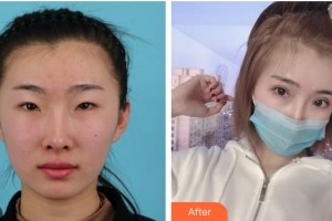 廈門大學(xué)附屬廈門眼科中心醫(yī)院任小軍整形價(jià)格表附全切雙眼皮+開內(nèi)眼角+開外眼角案例展示