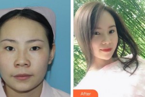 廈門大學(xué)附屬廈門眼科中心醫(yī)院楊麗杰整形價(jià)格表附精細(xì)切開雙眼皮案例展示