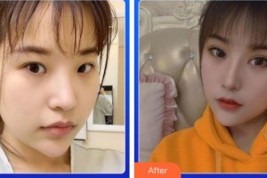 廈門大學(xué)附屬廈門眼科中心醫(yī)院王晶整形價(jià)格表附切開重瞼伴提肌+內(nèi)眥開大術(shù)案例展示