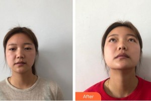 廈門大學(xué)附屬?gòu)B門眼科中心醫(yī)院王晶整形價(jià)格表附美眼部手術(shù)案例展示