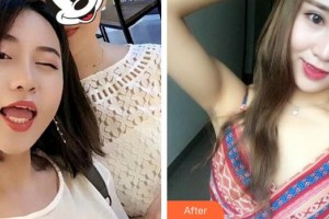 廈門大學(xué)附屬?gòu)B門眼科中心醫(yī)院王樂(lè)整形價(jià)格表附雙眼皮案例展示