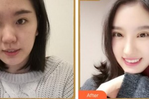 廈門大學(xué)附屬?gòu)B門眼科中心醫(yī)院李孟瓊整形價(jià)格表附眼部綜合案例展示