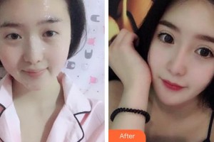 廈門大學(xué)附屬?gòu)B門眼科中心醫(yī)院周山整形價(jià)格表附眼部綜合案例展示