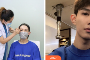 廣州中家醫(yī)家庭醫(yī)生醫(yī)學(xué)整形美容醫(yī)院趙蕓藝整形價(jià)格表附種植眉毛案例展示