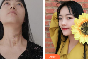 廣州愛來（原阿瑪施）醫(yī)療美容整形醫(yī)院唐福麟整形價(jià)格表附燙傷疤痕修復(fù)案例展示