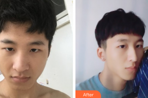 廣州解放軍第四五八醫(yī)院激光整形美容中心李筱珺整形價(jià)格表附鼻部手術(shù)案例展示