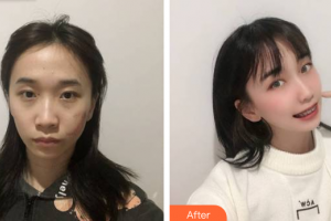 廣州鴻業(yè)醫(yī)學(xué)美容門診部劉相勇整形價(jià)格表附縫針疤痕案例展示