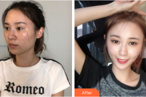 廣州鴻業(yè)醫(yī)學(xué)美容門診部陳杏整形價(jià)格表附點(diǎn)陣激光去痘印痘坑案例展示