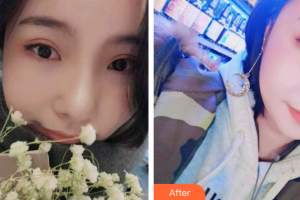 廣州新時(shí)代整形美容醫(yī)院文夫整形價(jià)格表附隱適美矯正案例展示