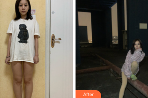 廣州瑞港醫(yī)療美容門診部盧顯碧整形價(jià)格表附吸脂瘦大腿案例展示