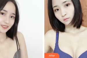 廣州現(xiàn)代醫(yī)院數(shù)字化整形美容中心黃小善整形價(jià)格表附自體脂肪隆胸案例展示