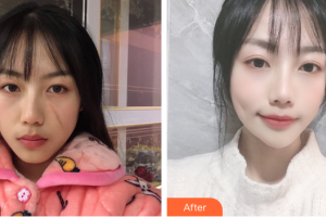 廣州愛來（原阿瑪施）醫(yī)療美容整形醫(yī)院吳文芹整形價(jià)格表附微創(chuàng)疤痕修復(fù)案例展示