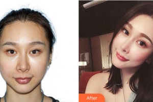 廣州麗尚整形美容門診部李軍整形價(jià)格表附頜面整形案例展示