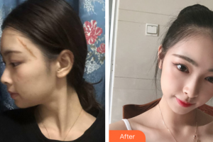 廣州中家醫(yī)家庭醫(yī)生醫(yī)學(xué)整形美容醫(yī)院賴崢嶸整形價(jià)格表附激光祛疤案例展示