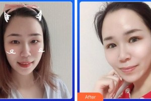 廈門大學(xué)附屬?gòu)B門眼科中心醫(yī)院李東侃整形價(jià)格表附眼部案例展示