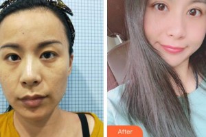 廈門大學(xué)附屬?gòu)B門眼科中心醫(yī)院徐法松整形價(jià)格表附上瞼提肌案例展示