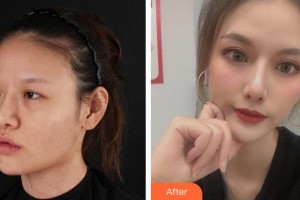 廈門大學(xué)附屬?gòu)B門眼科中心醫(yī)院徐靜靜整形價(jià)格表附眼部案例展示