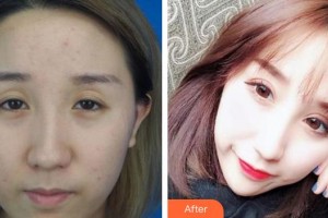 廈門大學(xué)附屬?gòu)B門眼科中心醫(yī)院歐陽(yáng)文博整形價(jià)格表附切開(kāi)雙眼皮案例案例展示