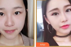 廈門大學(xué)附屬?gòu)B門眼科中心醫(yī)院范巍整形價(jià)格表附眼部綜合案例展示