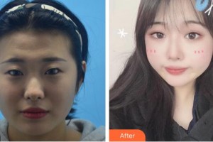 廈門大學(xué)附屬?gòu)B門眼科中心醫(yī)院林志榮整形價(jià)格表附埋線雙眼皮案例展示