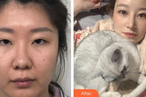 廈門大學(xué)附屬?gòu)B門眼科中心醫(yī)院商旭敏整形價(jià)格表附眼部整形案例展示