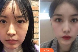 廈門大學(xué)附屬?gòu)B門眼科中心醫(yī)院董諾整形價(jià)格表附眼部案例展示