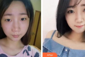 廈門大學(xué)附屬?gòu)B門眼科中心醫(yī)院葉梅整形價(jià)格表附自然雙眼皮案例展示