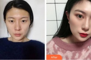 廈門大學(xué)附屬?gòu)B門眼科中心醫(yī)院付彥敏整形價(jià)格表附眼部手術(shù)案例展示