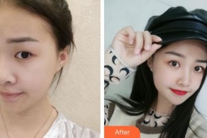 廈門大學(xué)附屬?gòu)B門眼科中心醫(yī)院莊建福整形價(jià)格表附眼部手術(shù)案例展示