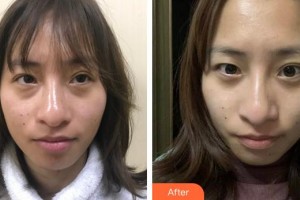 廈門大學(xué)附屬?gòu)B門眼科中心醫(yī)院修陽(yáng)暉整形價(jià)格表附不開(kāi)刀去眼袋+淚溝填充案例展示