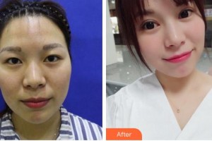 廈門大學(xué)附屬?gòu)B門眼科中心醫(yī)院陳雙成整形價(jià)格表附全切雙眼皮案例展示