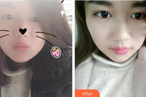 廈門大學(xué)附屬?gòu)B門眼科中心醫(yī)院楊美瓊整形價(jià)格表附眼部手術(shù)案例展示