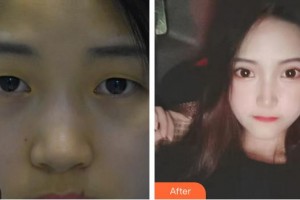 廈門大學(xué)附屬?gòu)B門眼科中心醫(yī)院陳文生整形價(jià)格表附眼部手術(shù)案例展示