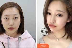 廈門大學(xué)附屬?gòu)B門眼科中心醫(yī)院何歡整形價(jià)格表附變身大眼“氣質(zhì)女孩”案例展示