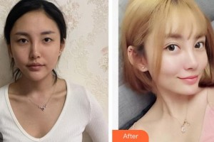 廈門大學(xué)附屬?gòu)B門眼科中心醫(yī)院楊梅整形價(jià)格表附眼部手術(shù)案例展示