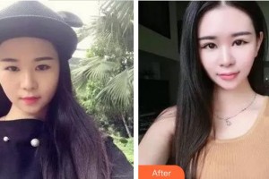 廈門大學(xué)附屬?gòu)B門眼科中心醫(yī)院沈政偉整形價(jià)格表附雙眼皮修復(fù)快三個(gè)月案例展示