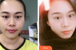 廈門大學(xué)附屬?gòu)B門眼科中心醫(yī)院王海燕整形價(jià)格表附眼部手術(shù)案例展示