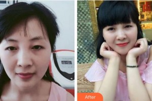 廈門大學(xué)附屬?gòu)B門眼科中心醫(yī)院揭黎明整形價(jià)格表附雙眼皮案例展示