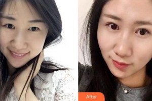 廈門大學(xué)附屬?gòu)B門眼科中心醫(yī)院胡繼發(fā)整形價(jià)格表附眼部綜合案例展示